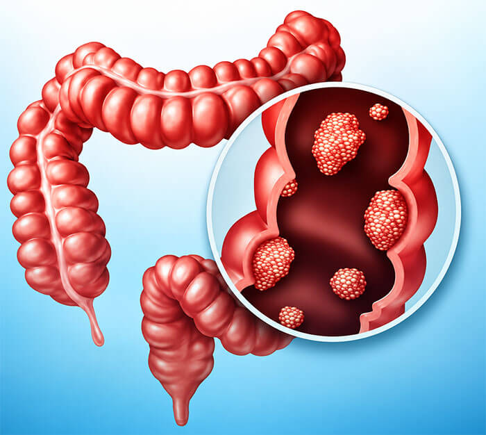 Understanding Colorectal Cancer