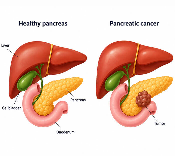Pancreatic Cancer Surgery