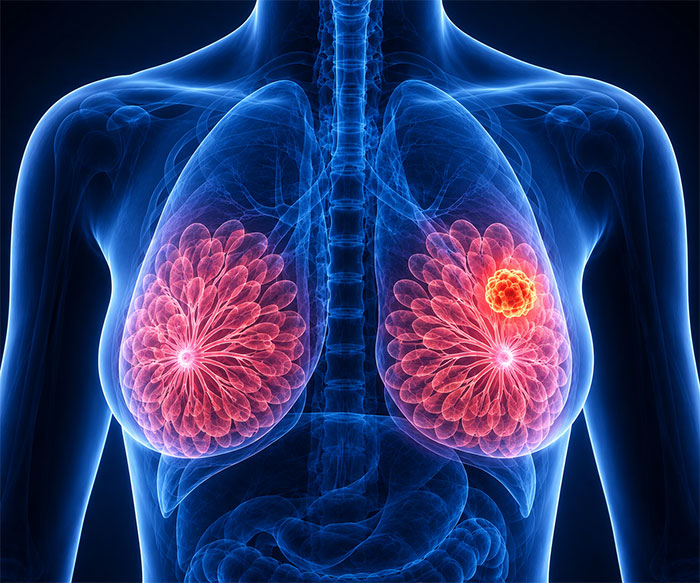 Breast Cancer Surgery