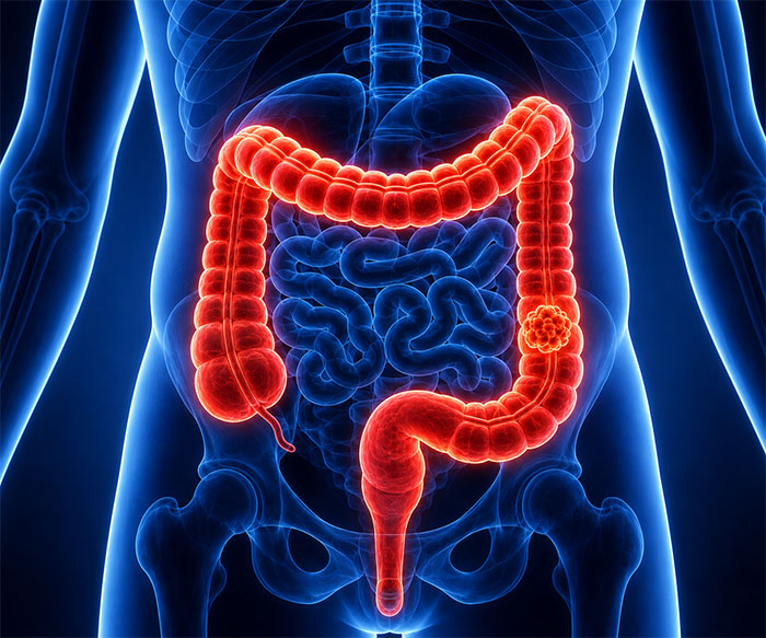 Colorectal Cancer Surgery