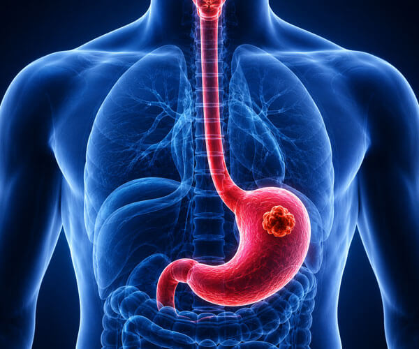 Gastrointestinal & Hepatobiliary Cancer Surgery