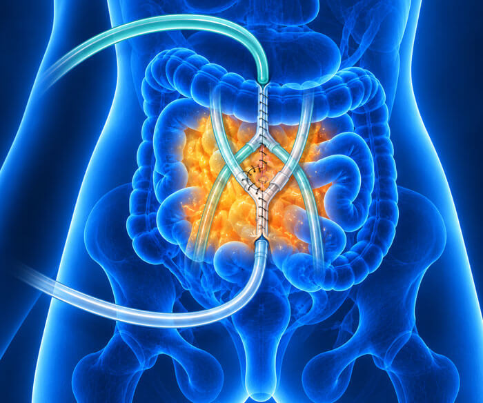 Peritoneal Surface Malignancy Management (HIPEC, PIPAC)