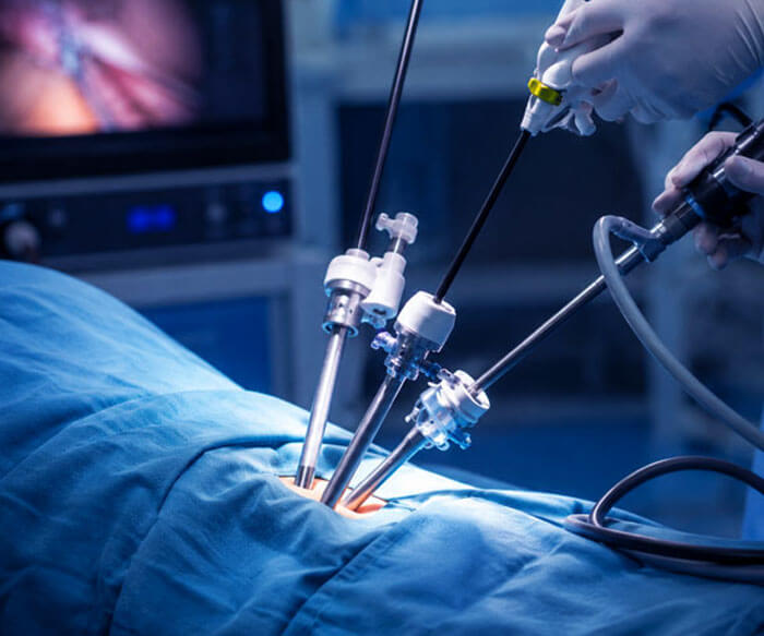 Laparoscopic Cancer Surgery
