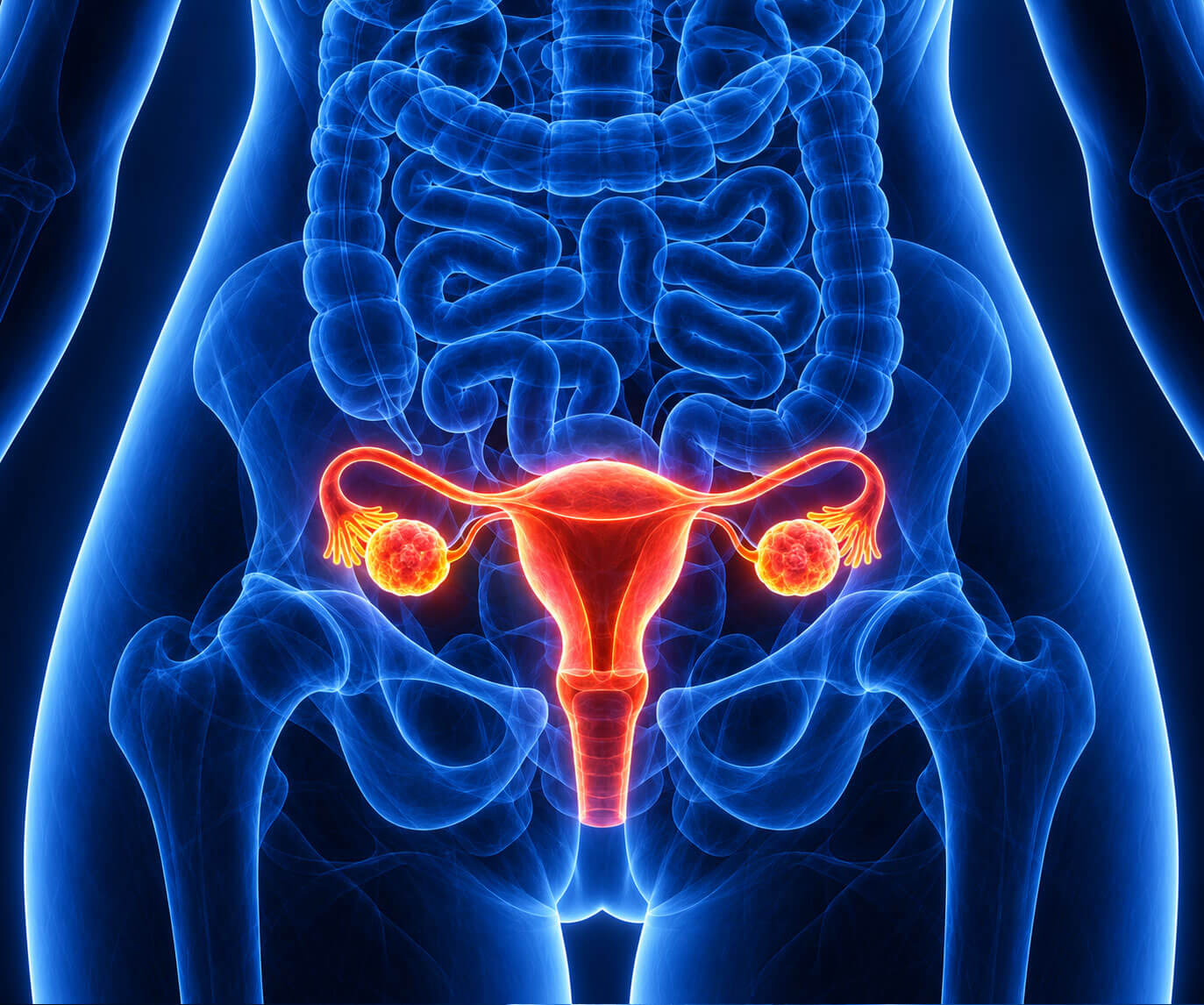 Ovarian Cancer Surgery